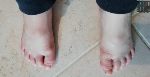 Infiammazioni nodulari ai piedi dei bambini, ricerca barese svela: �C'entra il Coronavirus�